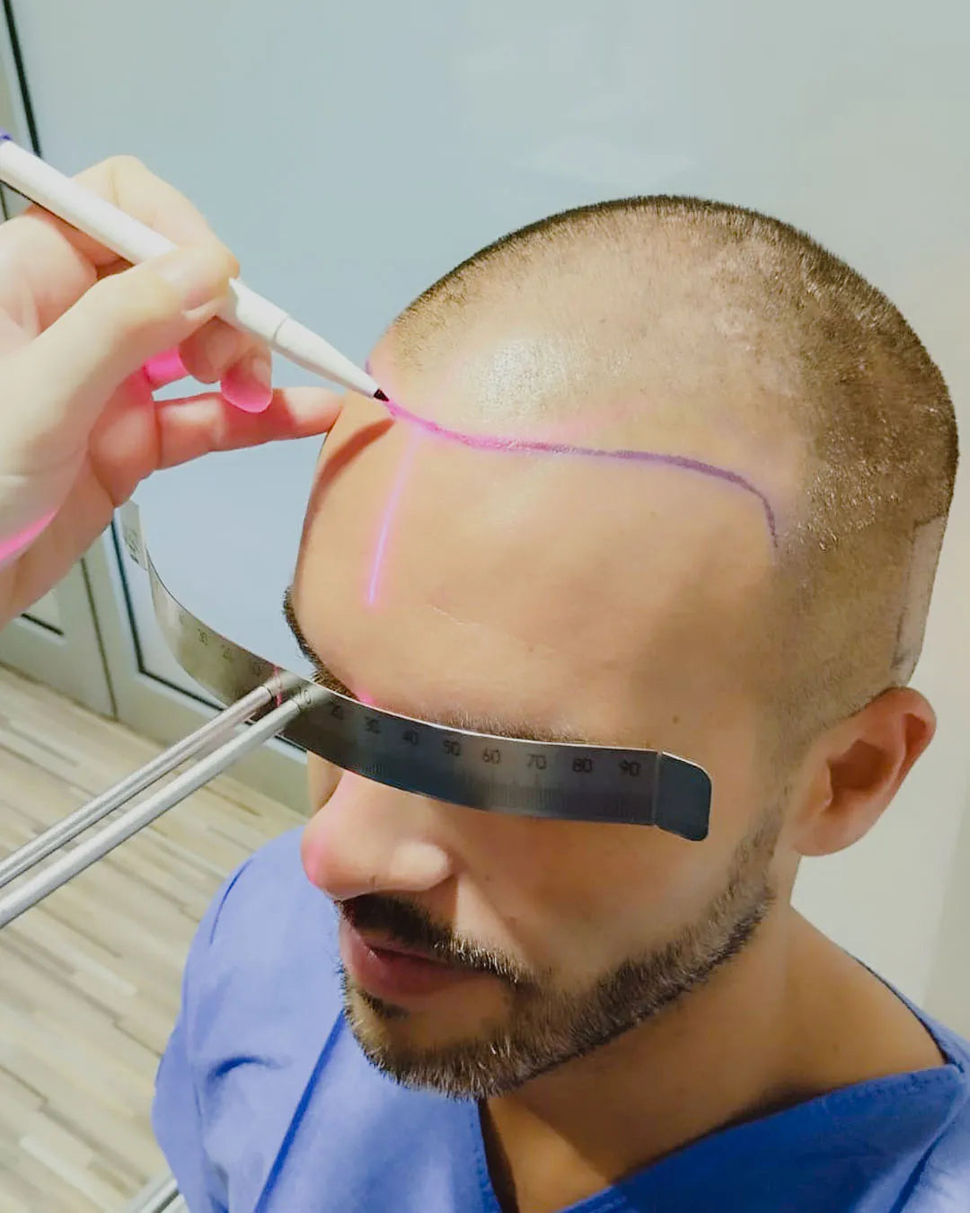 Láser de diseño lineal frontal transplante capilar
