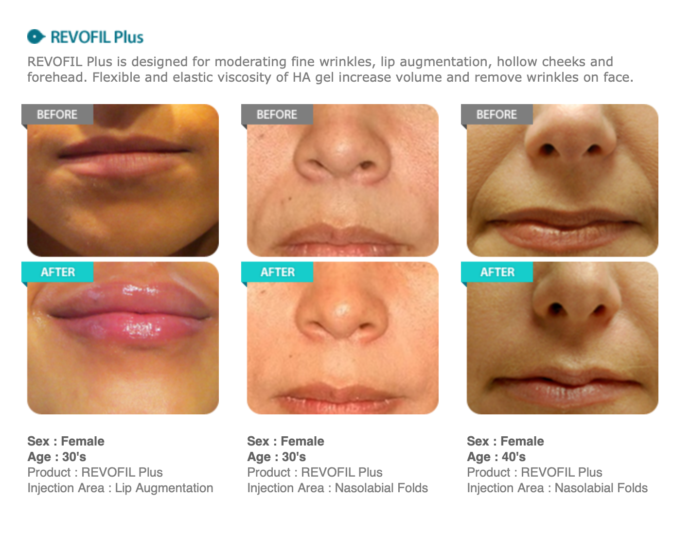 Revofil Plus antes y después